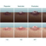 Asal Usul Cacar Monyet, Gejala dan Cara Penularanya